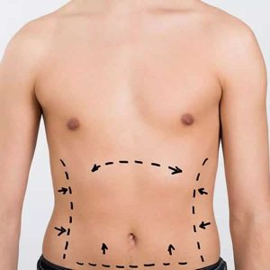 Abdomen (abdominoplastía)