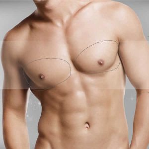 Implante pectoral (hombre)